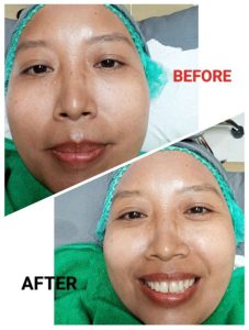 Hasil perawatan ZAP Photo Facial Glow